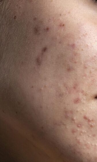 portrait-beautiful-young-woman-with-acne