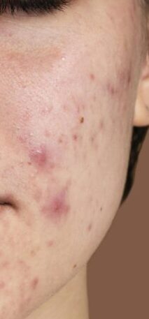 portrait-young-woman-being-confident-with-her-acne